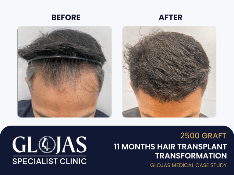 tanam-rambut-11 bulan