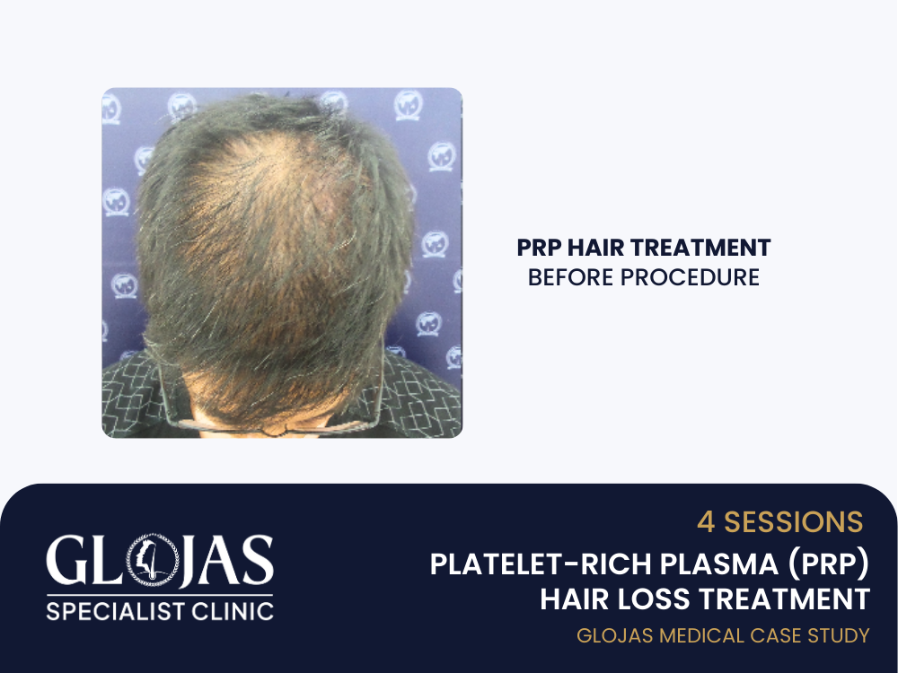 prp-hair-loss-treatment-before