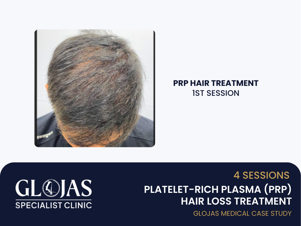 prp-hair-loss-treatment-session-1