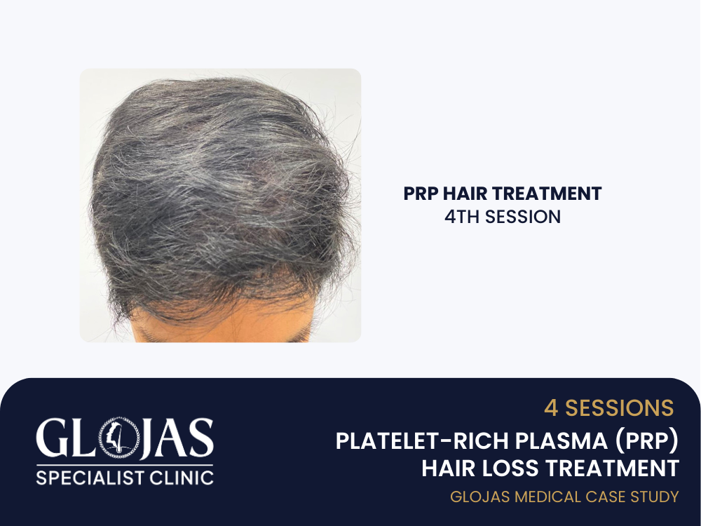 prp-hair-loss-treatment-session-4