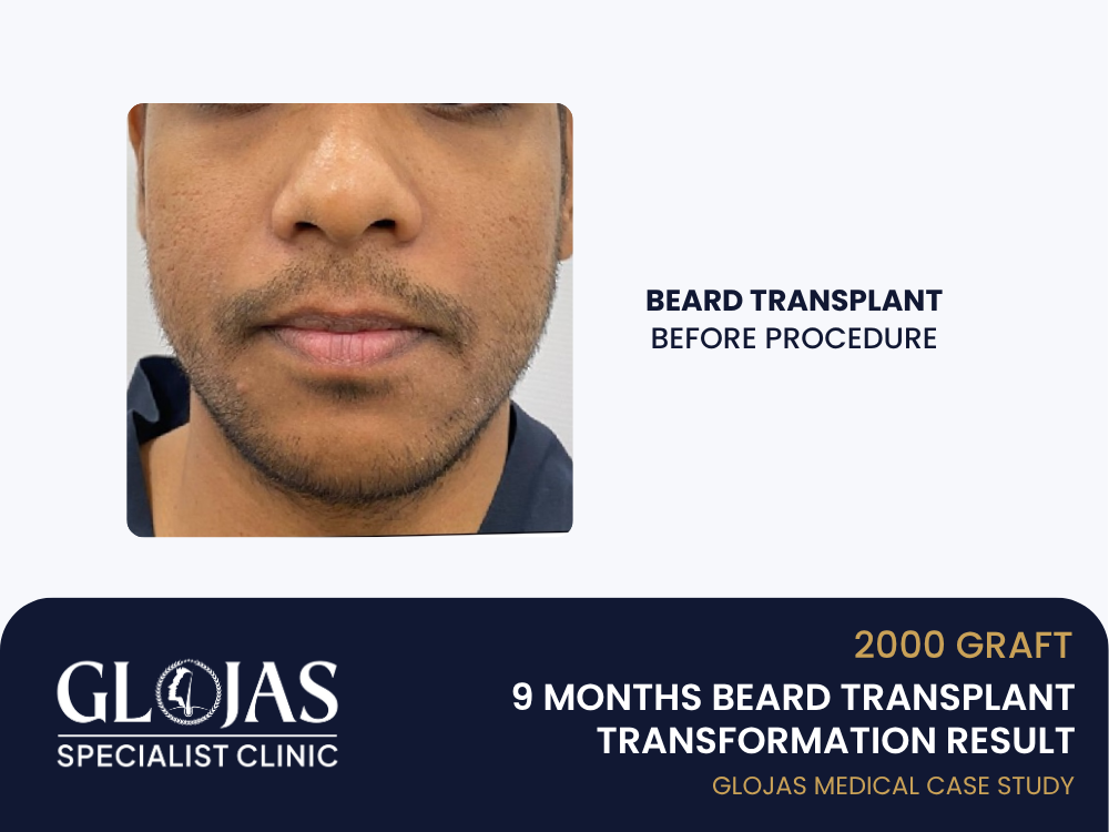 beard-transplant-before 