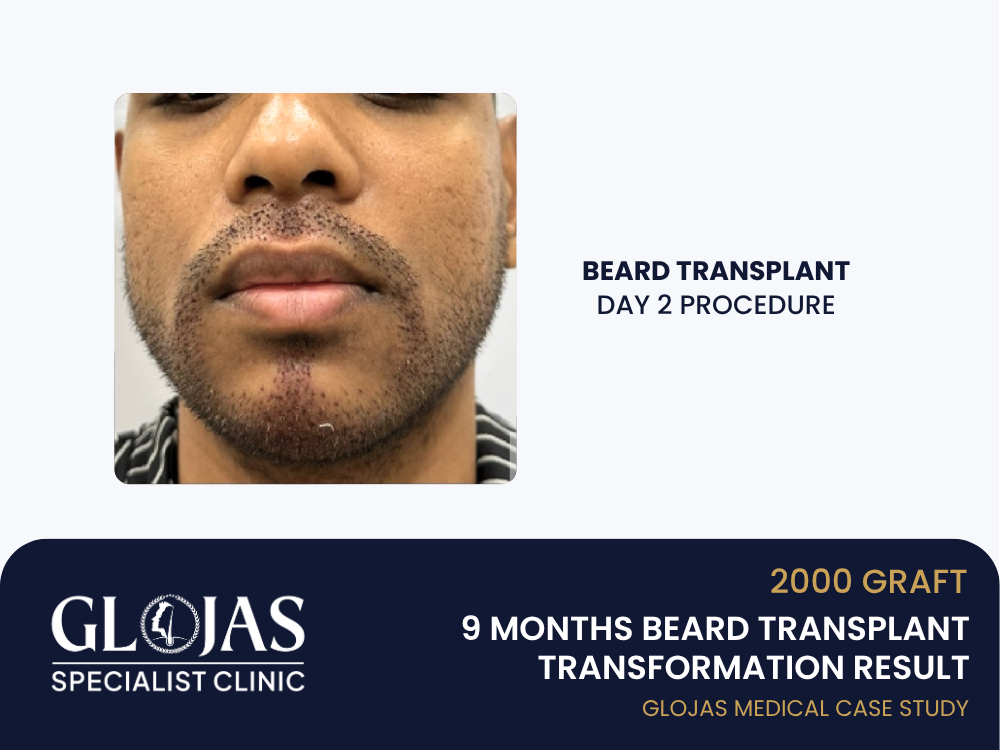 beard-transplant-day-1