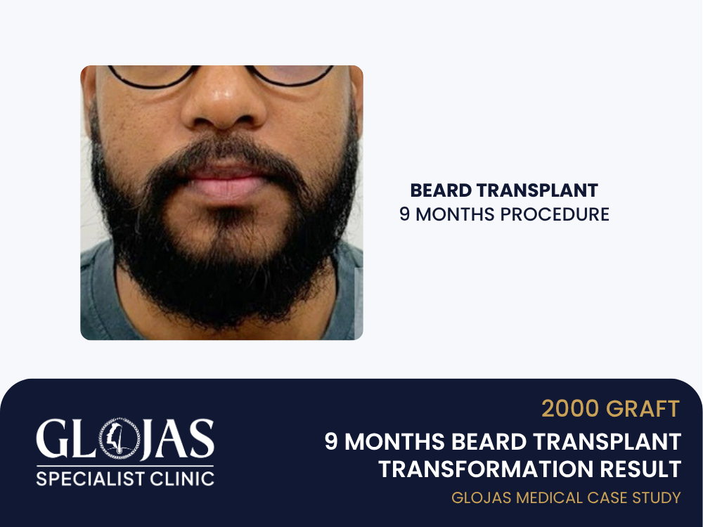 beard-transplant-9-months