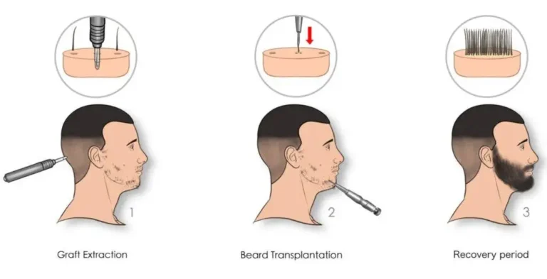 Beard Hair Transplant Processwebp