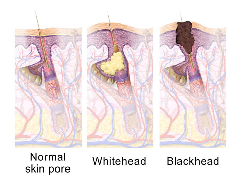 blackheads-comedo