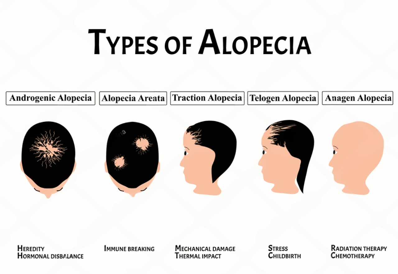 alopecia-areata
