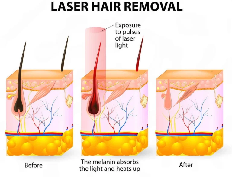 permanent-laser-hair-removal-kuala-lumpur-malaysia