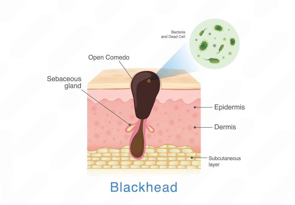 blackheads-comedo