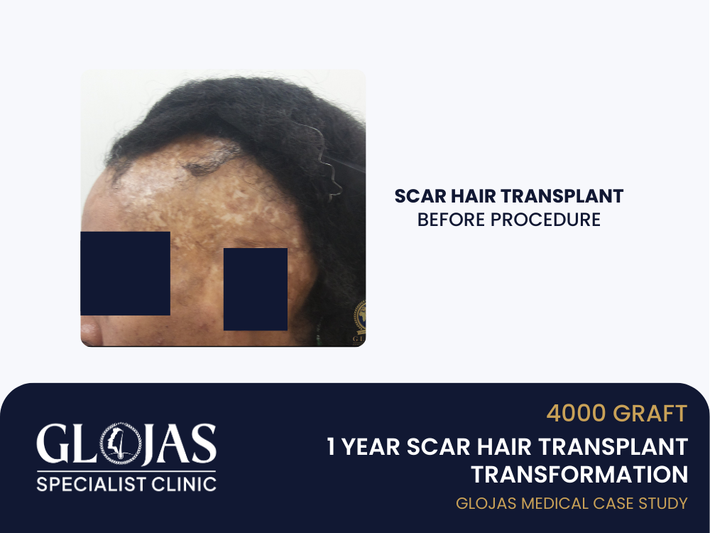 scar-hair-transplant-before