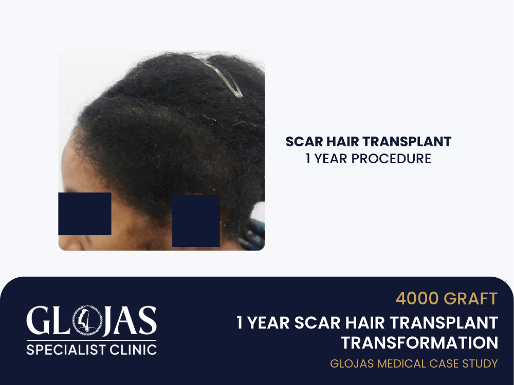 scar-hair-transplant-1-year