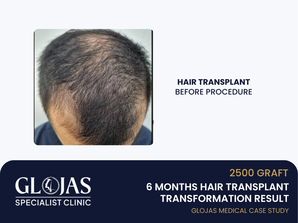 hair-transplant-before