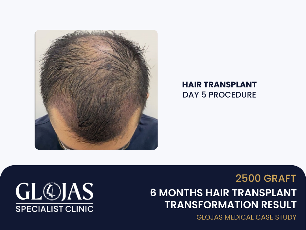 hair-transplant-day-5