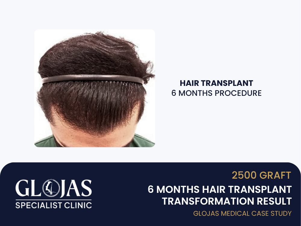 hair-transplant-6-months