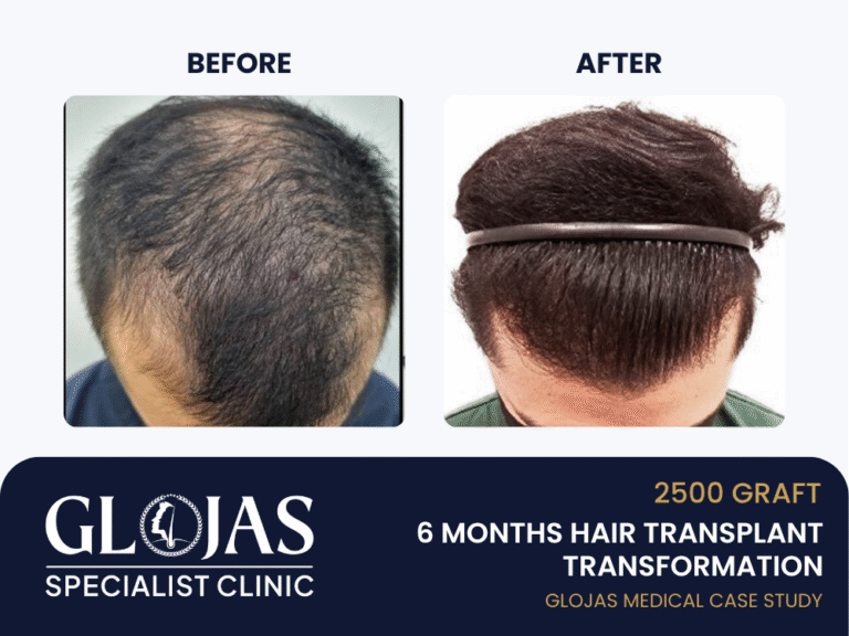 tanam-rambut-6-bulan-hasil