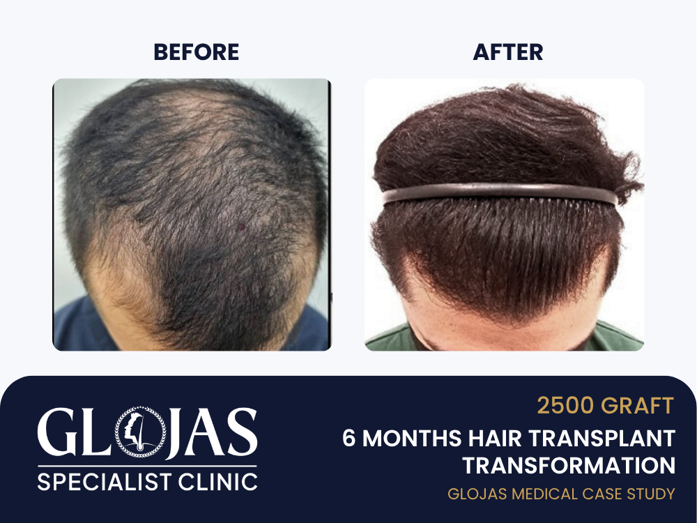 Kajian Kes: Tanam Rambut – Hasil 6 Bulan dengan 2,500 Graft untuk Male Pattern Hair Loss Tahap 4 (Vertex)