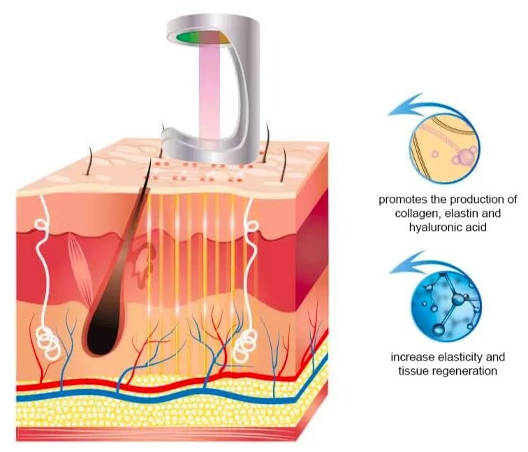 fractional-co2-laser