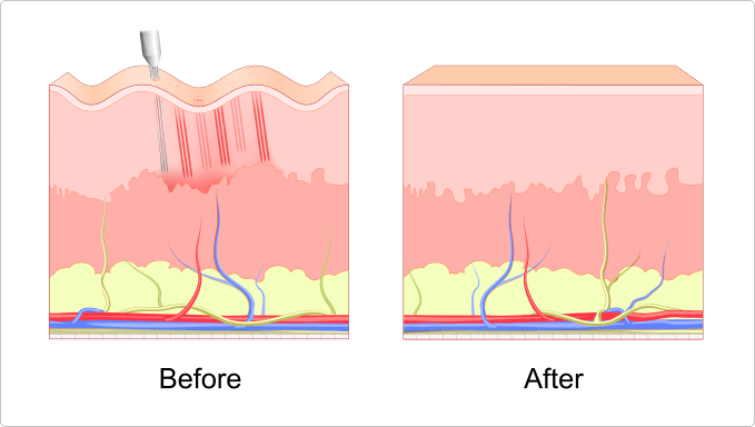 microneedling-treatment-malaysia-kuala-lumpur