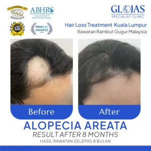 alopecia-rambut-gugur