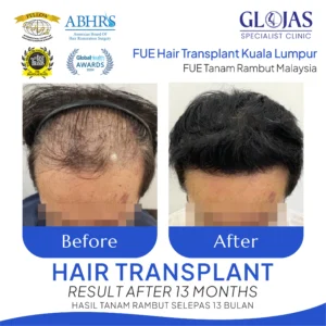 tanam-rambut malaysia