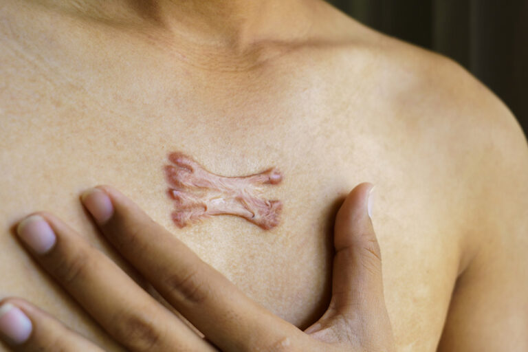 keloid-scar-treatment-malaysia