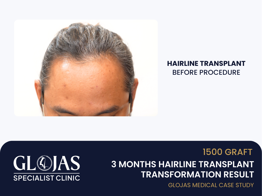 hairline-transplant-before