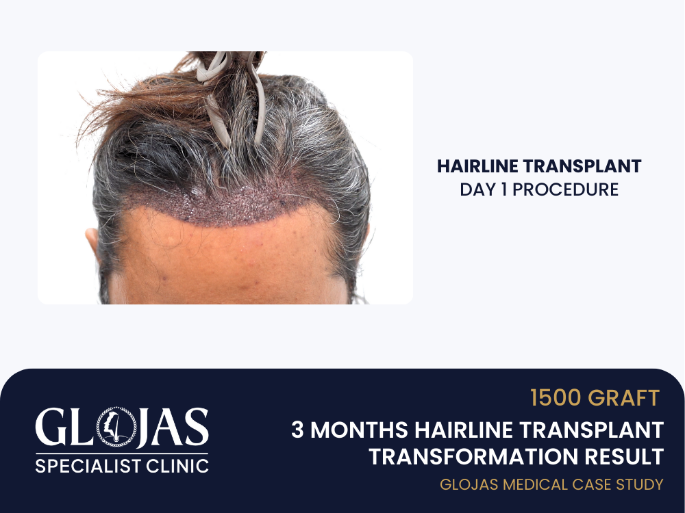 hairline-transplant-day-1