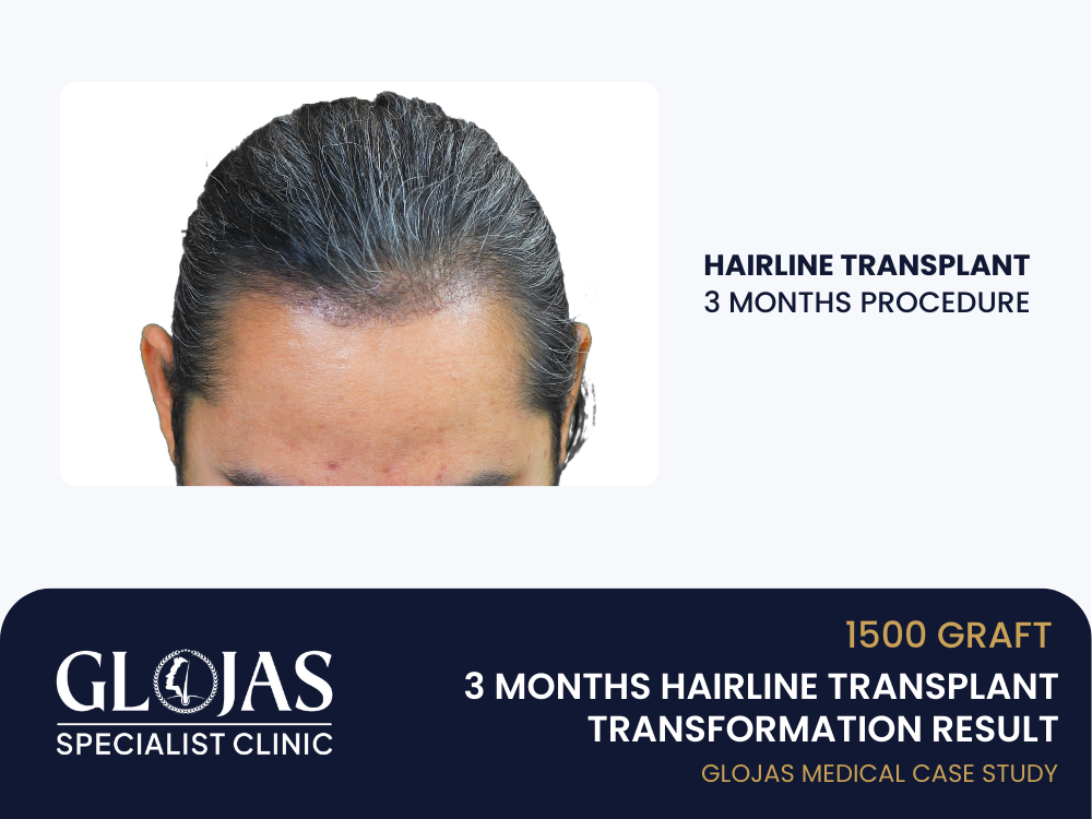 hairline-transplant-3-months