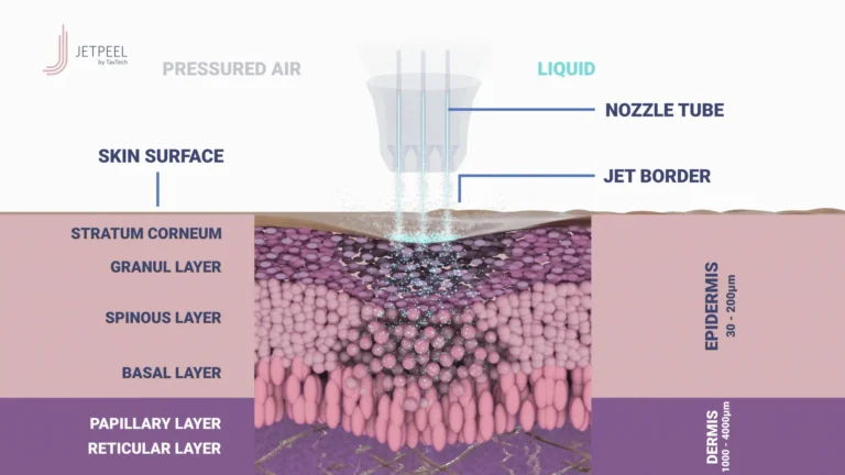 jet-peel-facial