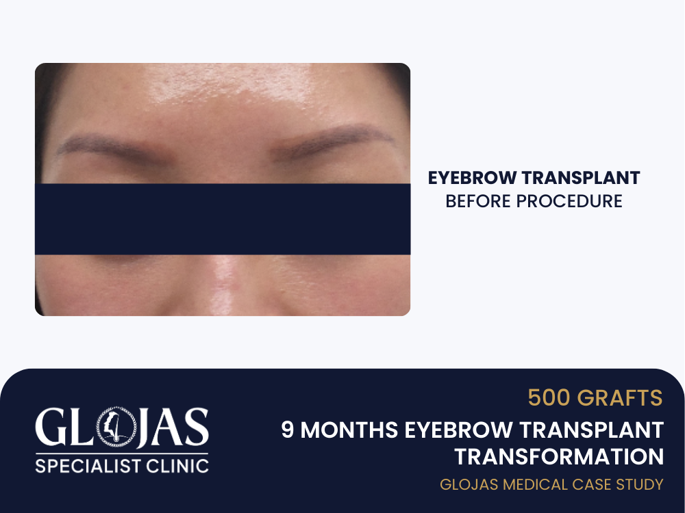 tanam-kening-sebelum