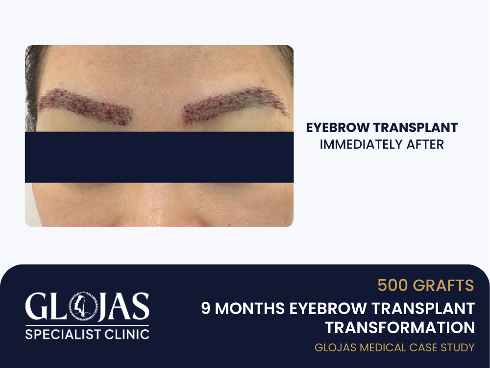 tanam-kening-sejurus-selepas