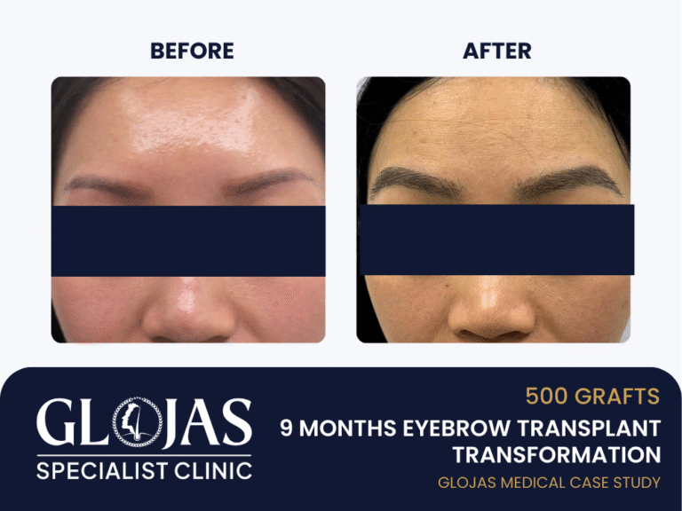 tanam-kening-hasil