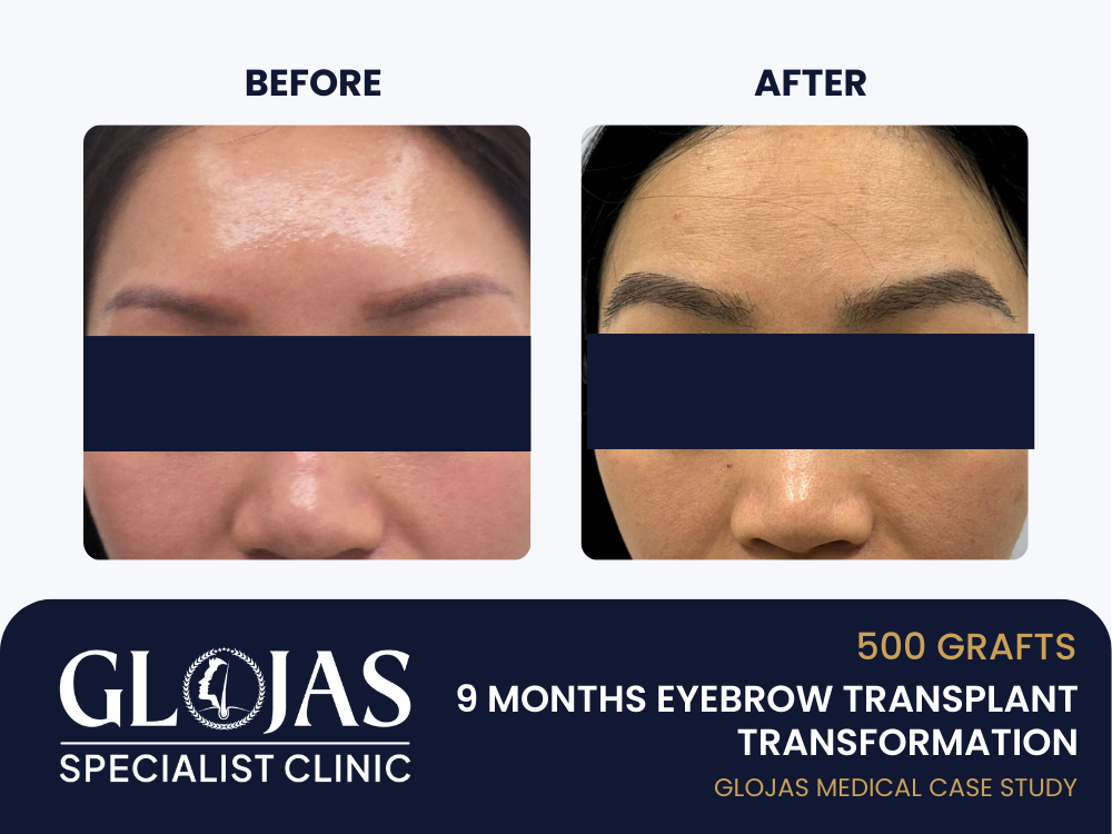 Kajian Kes: Tanam Kening SMART™ FUE – Hasil Selepas 9 Bulan dengan 500 Graft untuk Kening Nipis