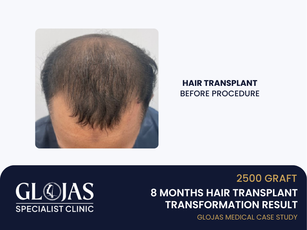tanam-rambut-sebelum