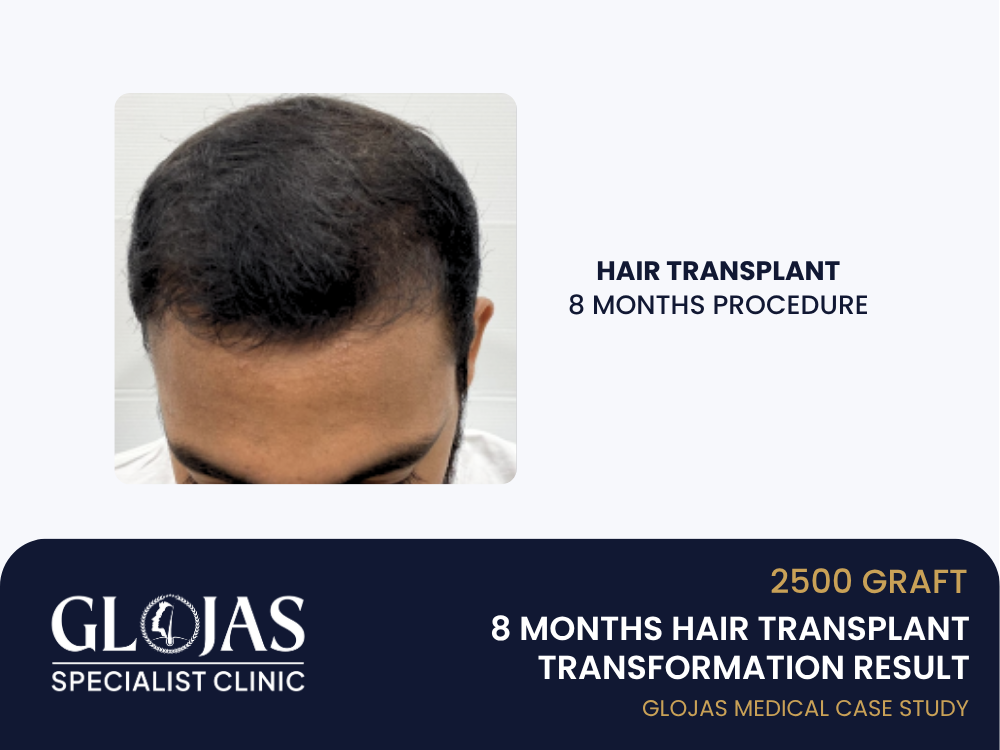 tanam-rambut-8-bulan