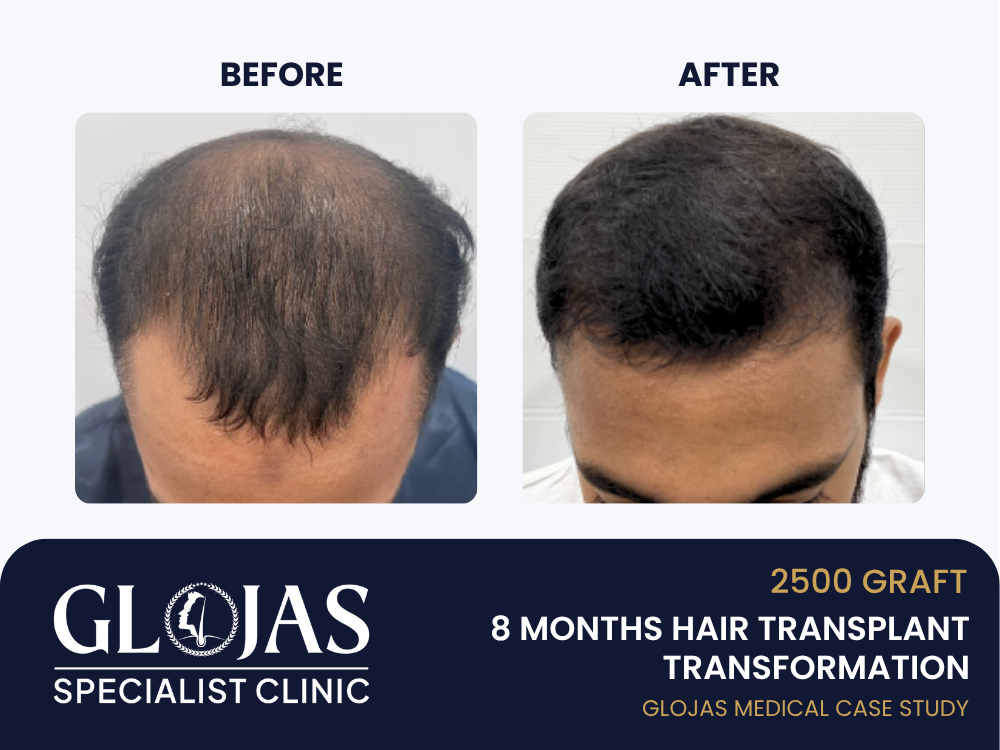 Kajian Kes: Tanam Rambut – Hasil 8 Bulan dengan 2,500 Graft untuk Kebotakan Lelaki Tahap 3 (Vertex) 18 tanam-rambut-hasil-8-bulan