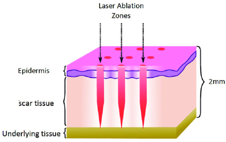 fractional-co2-laser-kuala-lumpur-malaysia