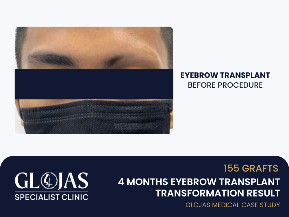 eyebrow-transplant-before