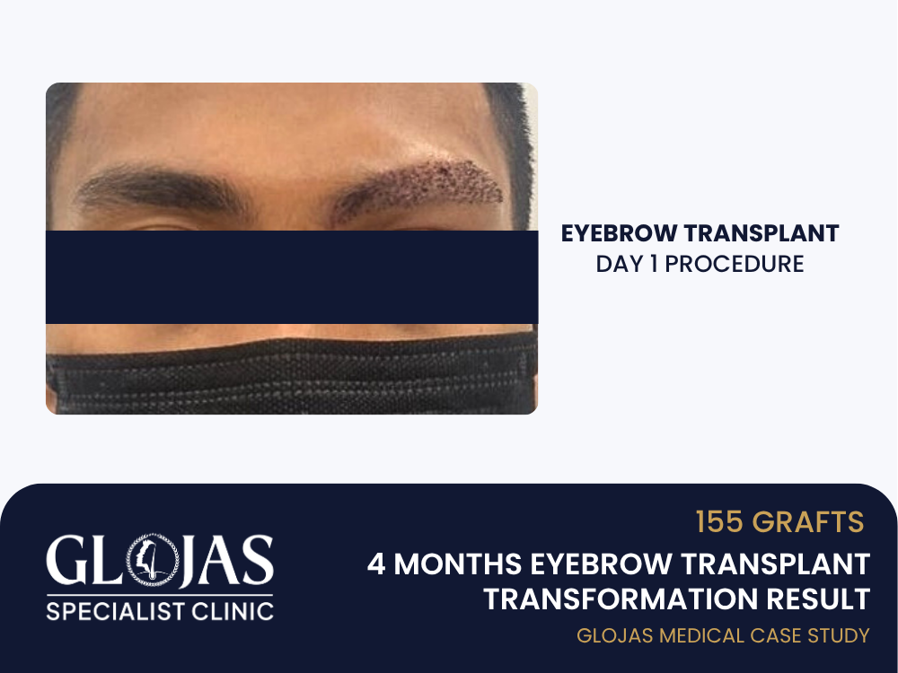 eyebrow-transplant-day-1