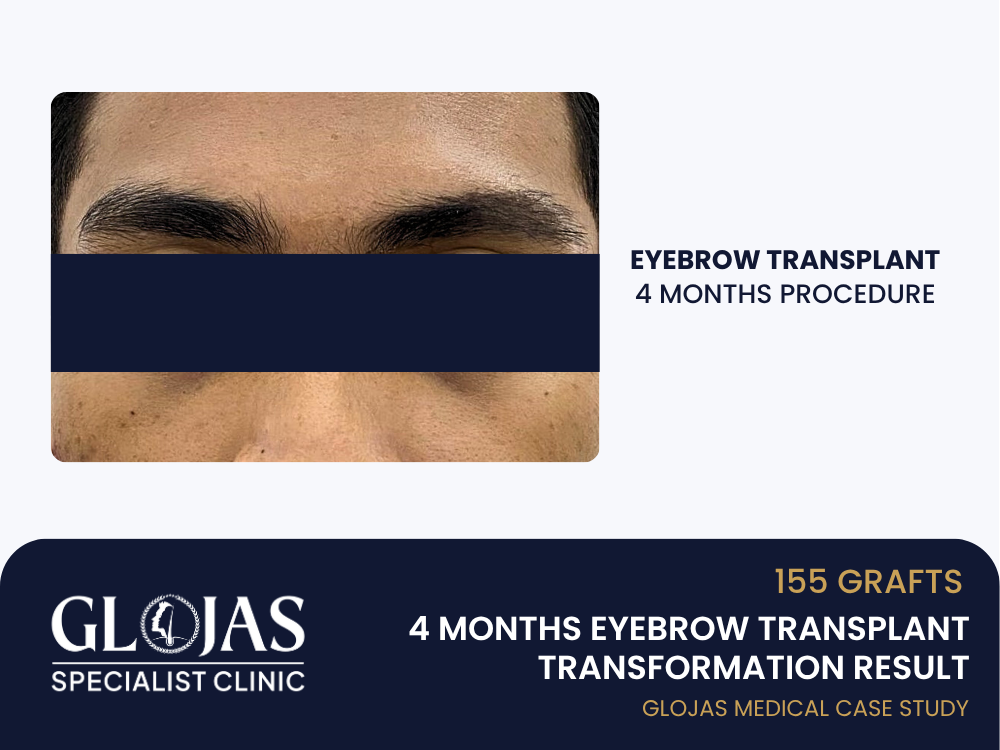 eyebrow-transplant-4-months