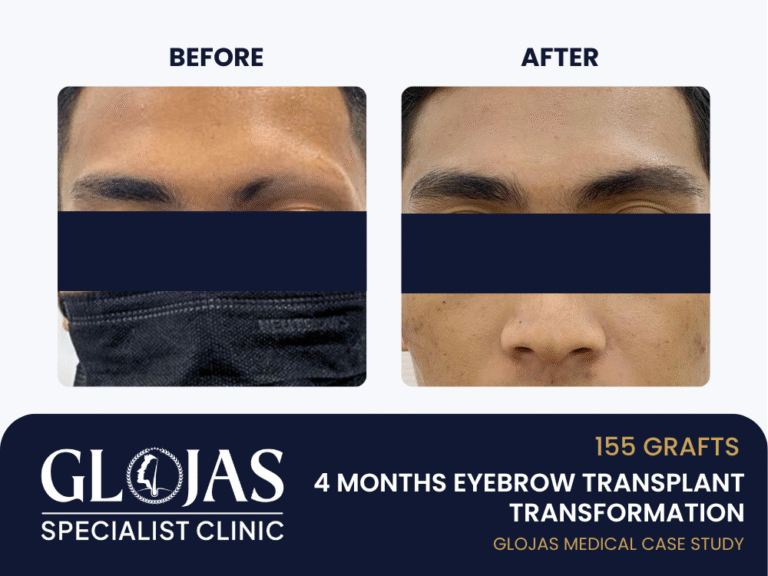 tanam-kening-parut