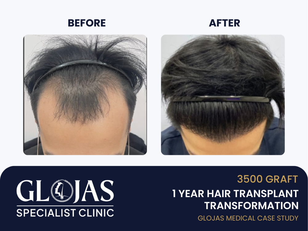Kajian Kes: Tanam Rambut SMART™ FUE – Hasil Selepas 1 Tahun dengan 3500 Graft untuk Botak Corak Lelaki Tahap 3