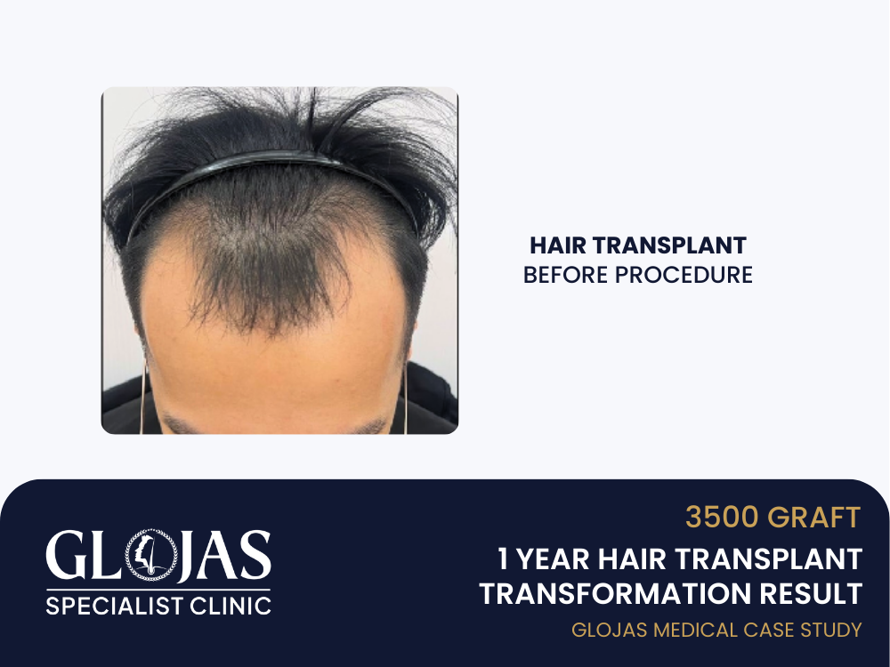 hair-transplant-before