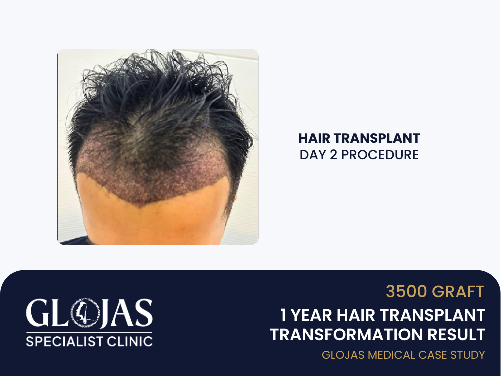 hair-transplant-day-3