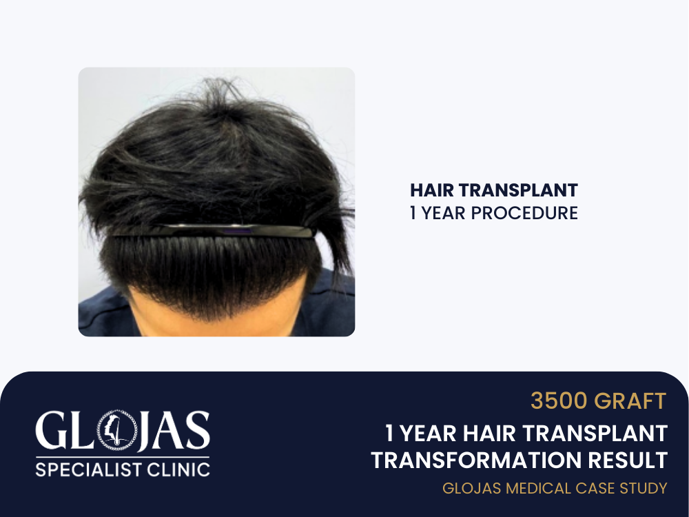 hair-transplant-1-year