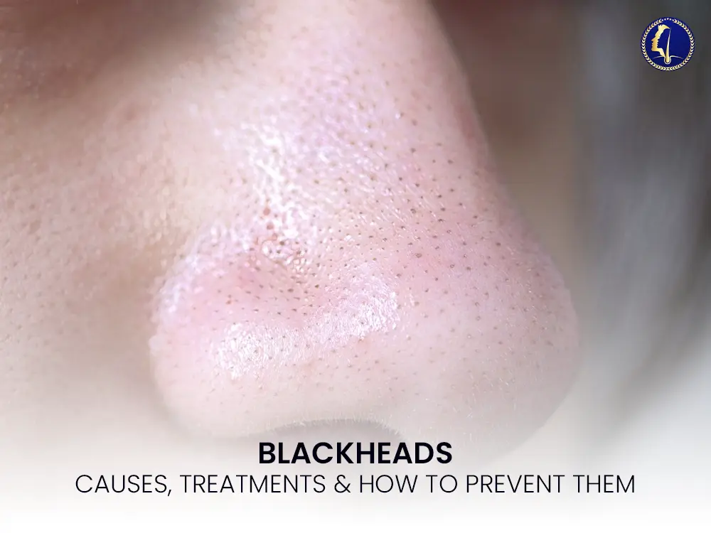 What Are Blackheads? Causes, Treatments & How to Prevent Them