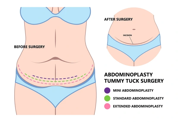 mini-tummy-tuck-malaysia-specialist-clinic-glojas