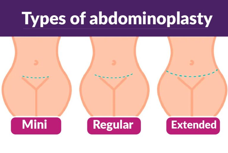 mini-tummy-tuck-malaysia-specialist-clinic-glojas
