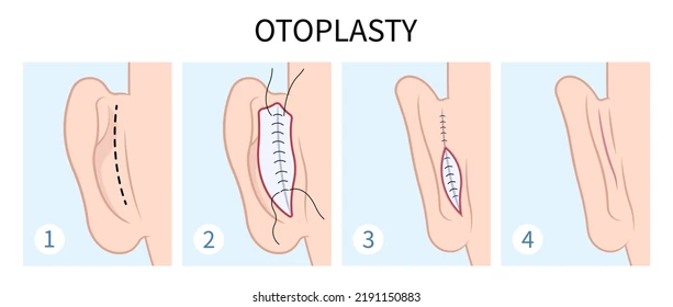 otoplasty-surgery-malaysia-glojas-clinic