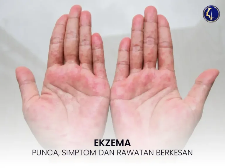 ekzema