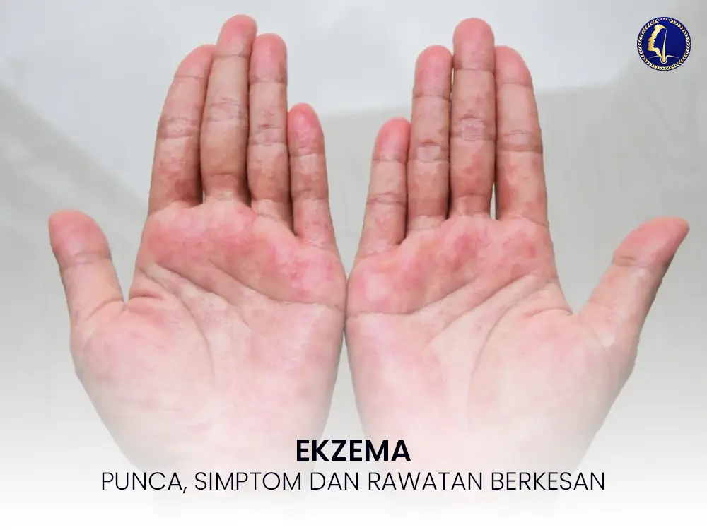 ekzema